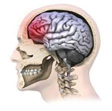 What is a concussion? A concussion is a traumatic injury to the soft tissue of the brain as a result of a violent blow.