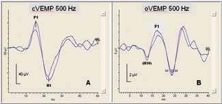 VEMP test A myogenic response from muscles of the neck or eyes, in response to loud acoustic stimulation.