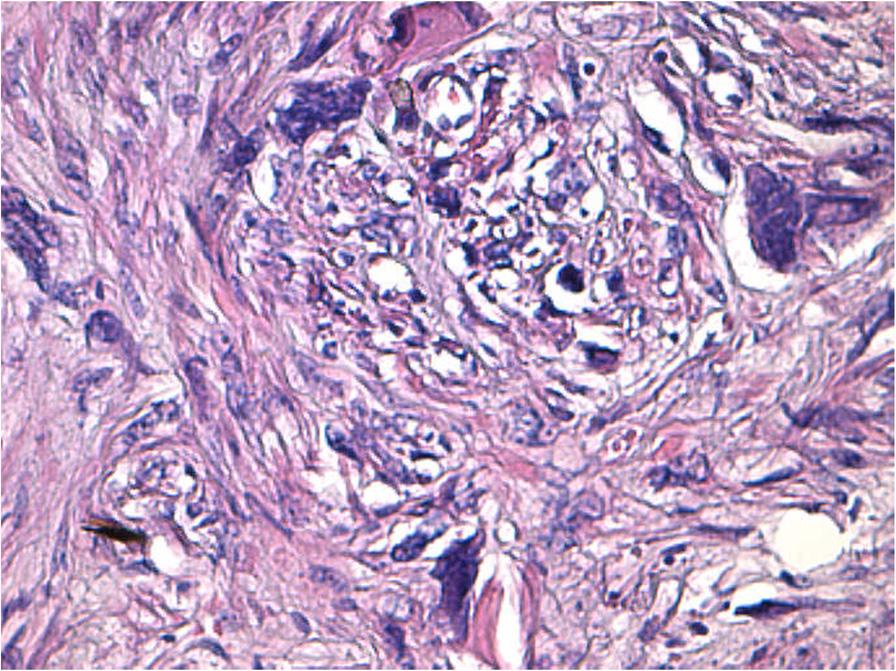 benign but should be considered tumors of low malignant potential because they can occasionally recur, in some cases, years after hysterectomy.