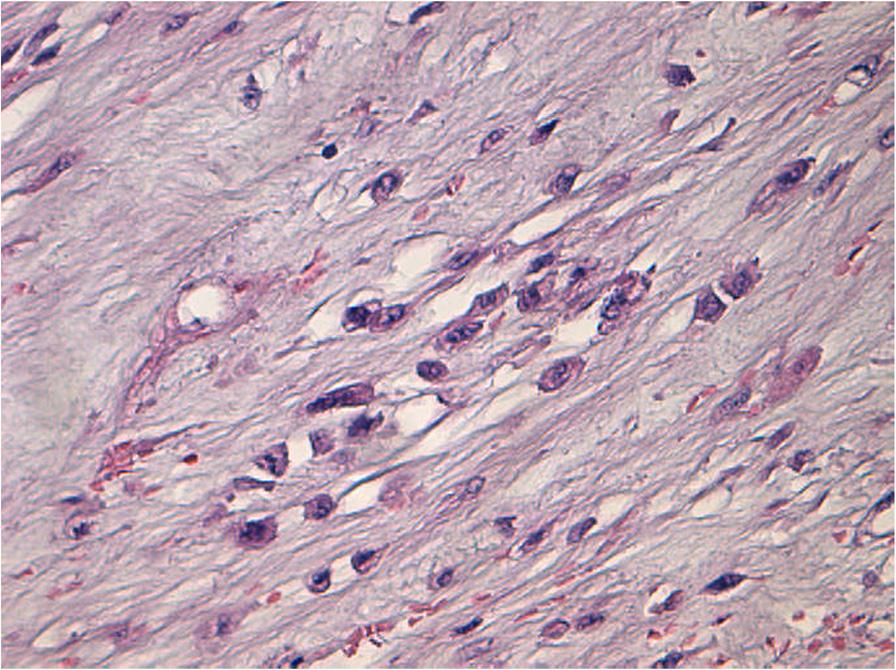 Fig. 3 Atypical cells, hematoxylin and eosin stain 20 expressed a low proliferation index (Fig. 10), whereas p21 and p53 were negative. The final diagnosis of our case was ALM.