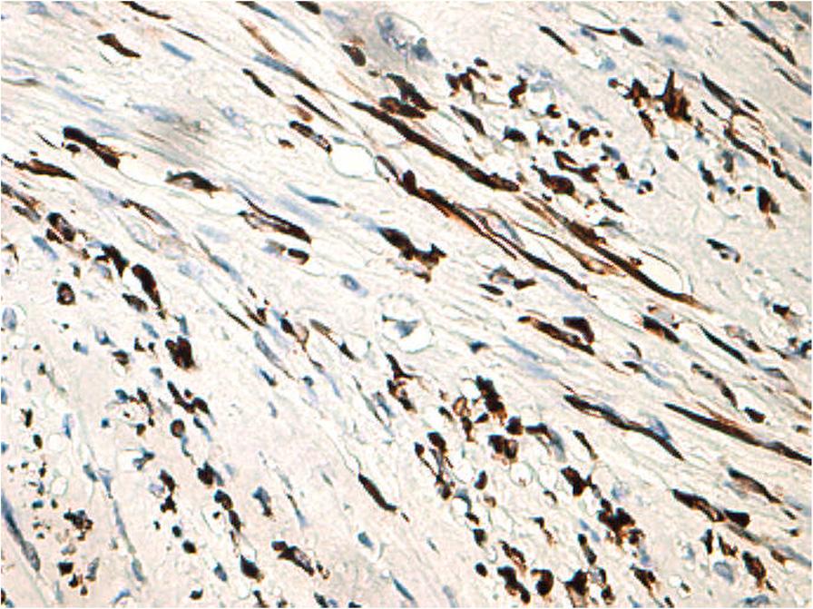 5 Smooth muscle actin+, 20 Cell cycle regulatory protein expression by immunohistochemical assay may have diagnostic utility in the distinction of uterine LMS from LM variants.