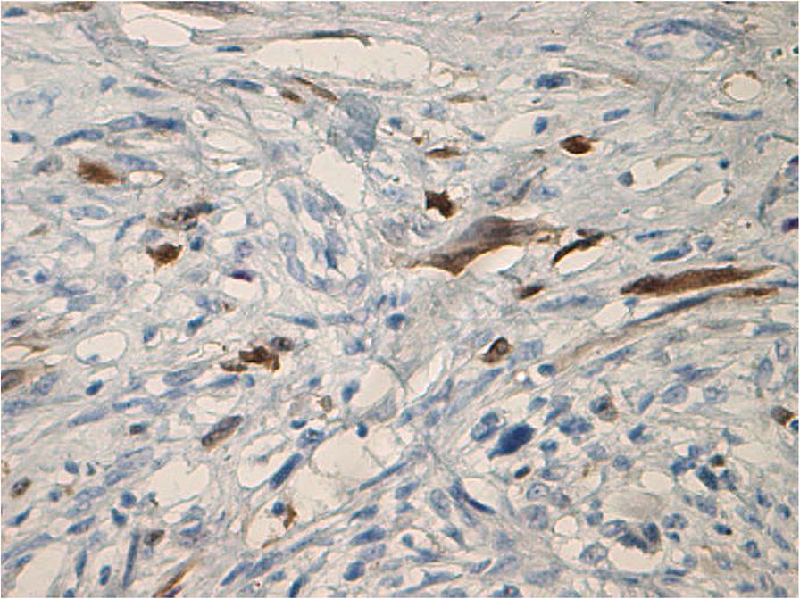 Fig. 7 Cyclin-dependent kinase inhibitor 2A, focally positive, 20 a variety of cells. In addition, bcl-2 can promote cell replication by reducing the requirement for growth factors.