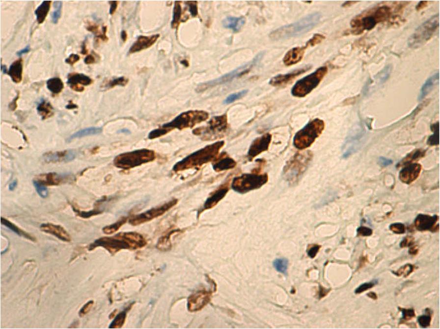 Similarly, bcl-2 in our case showed positive staining of atypical cells, supporting the diagnosis of ALM.