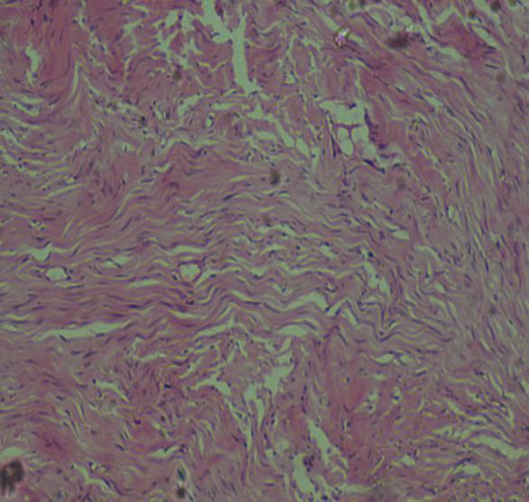 Figure 3: A. show fascicles of spindle cells with serpentine nuclei having pointed ends B.