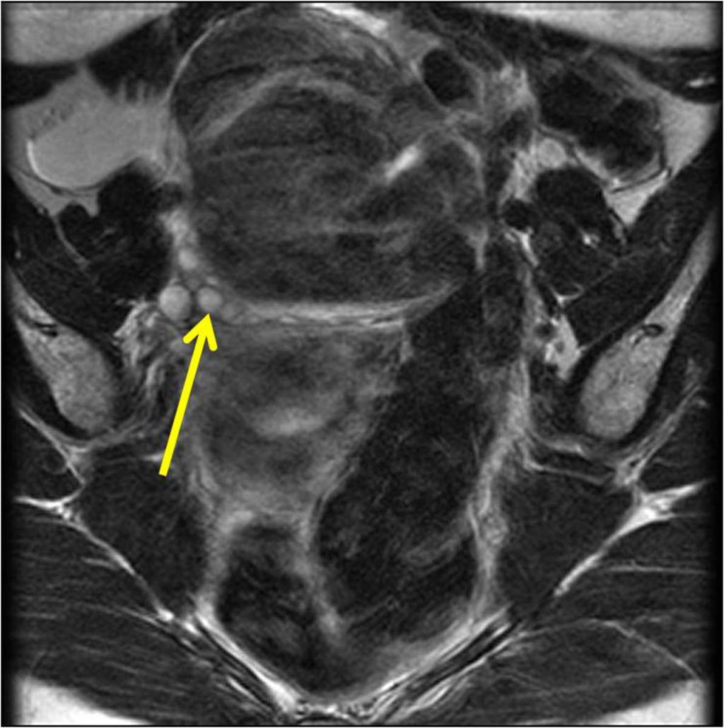 Fig. 10: Oblique T2-weighted image shows small multilocular cysts are around the mass.