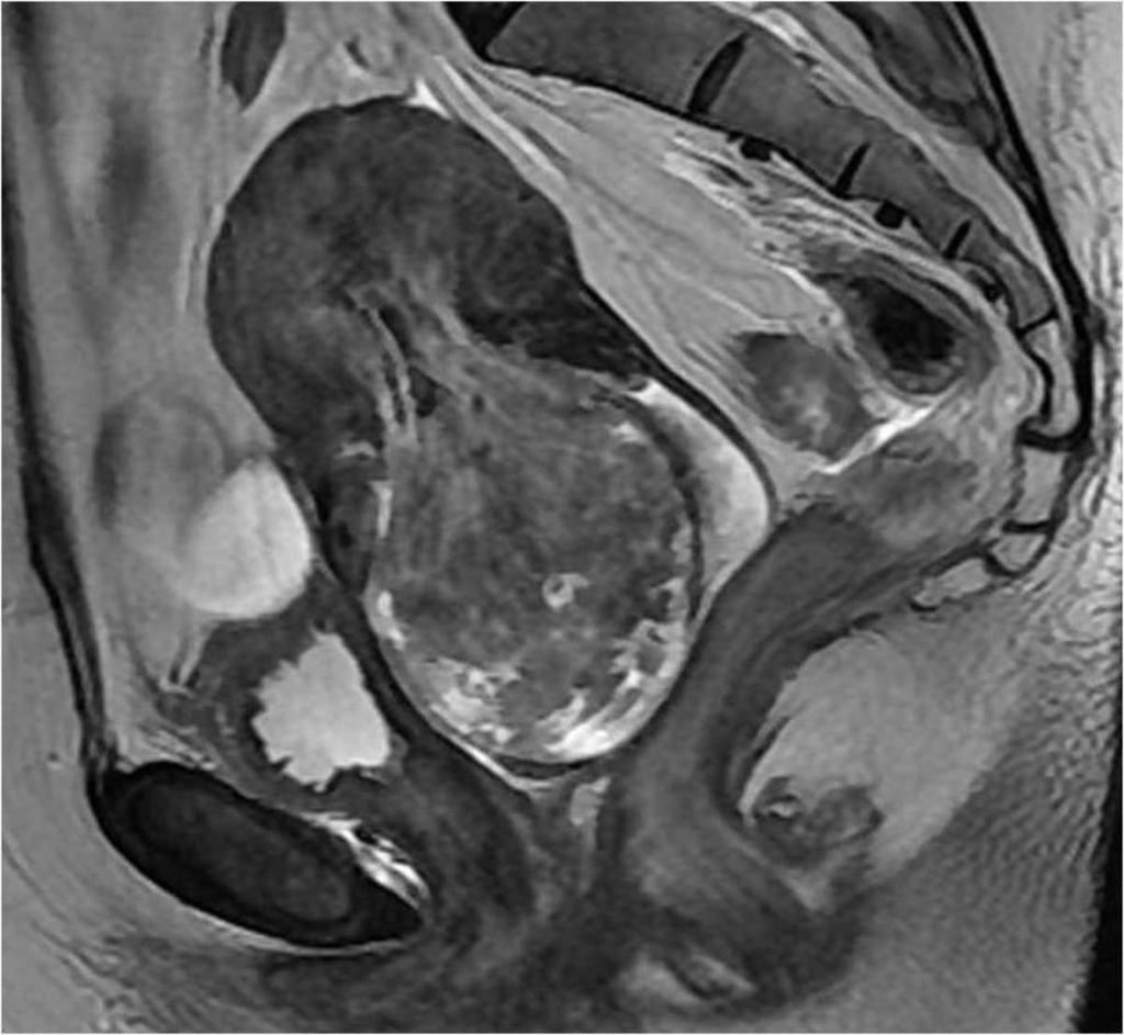 Fig. 11: Sagital T2-weighted image shows pedunculated leiomyoma