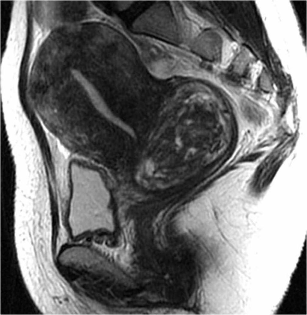Fig. 12: Sagittal T2-weighted image shows distinct