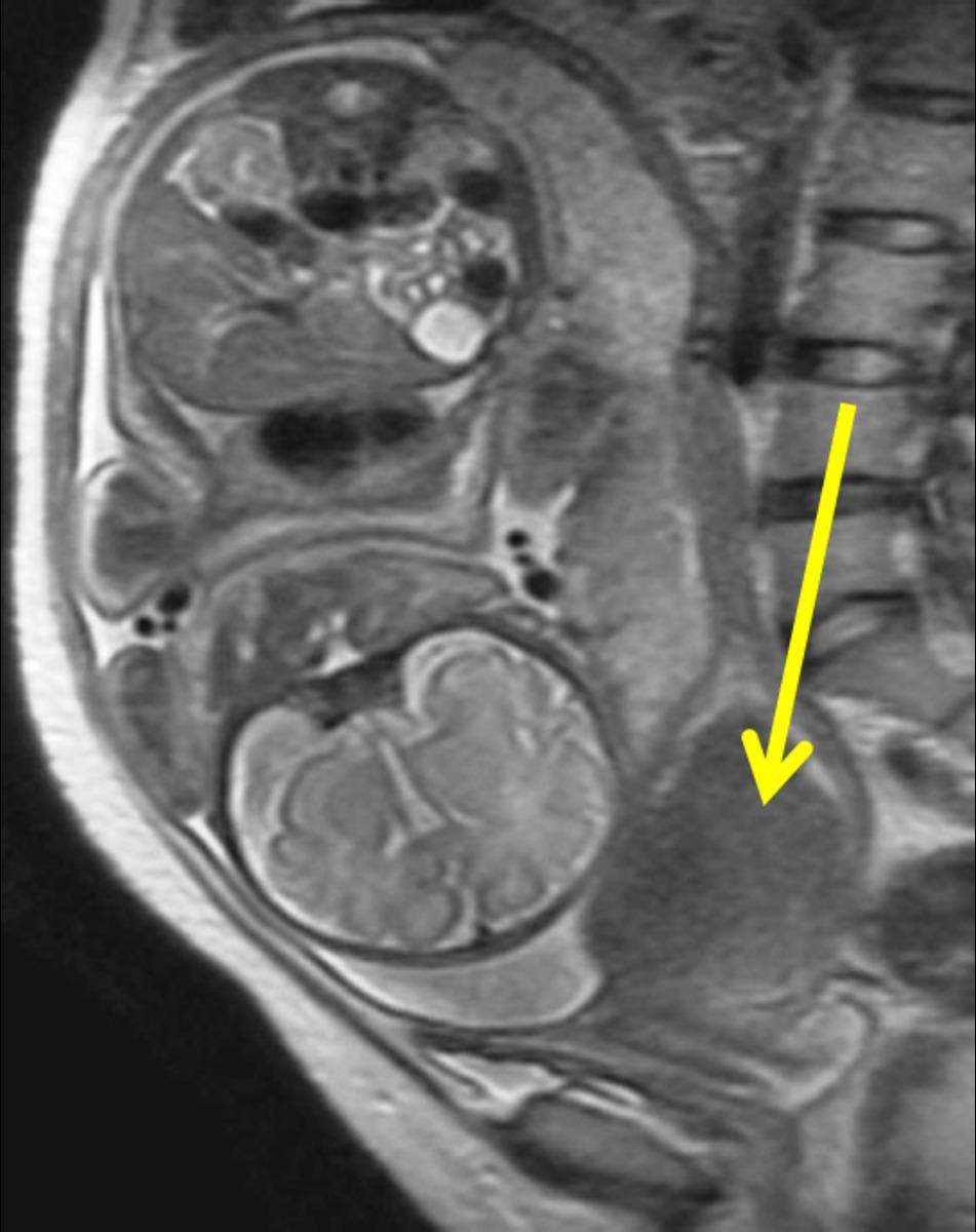 Fig. 13: Intramural leiomyoma in the lower uterine segment in a 30-year-old-woman.
