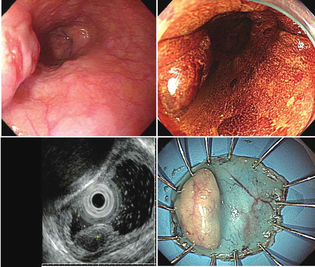 A B C D Fig. 5. (A) The endoscopic images show a subepithelial tumor with an eroded hyperemic lesion in the lower esophagus. (B) Lugol chromoendoscopy shows the iodine-unstained lesion.
