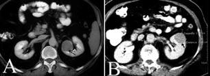 Figure 1. Magnetic resonance showing two tumor masses in the left kidneys of case 1 (A) and case 3 (B). Figure 2. Macroscopic view of two intrarenal tumour masses with a solid yellowish cut surface.