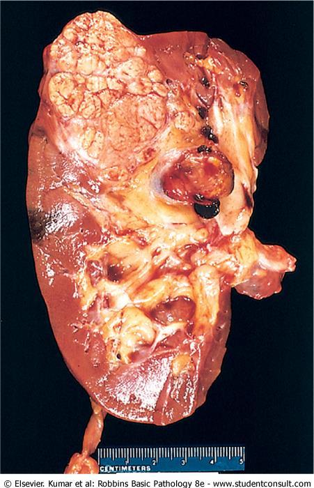 Renal cell carcinoma: yellowish, spherical neoplasm in one pole