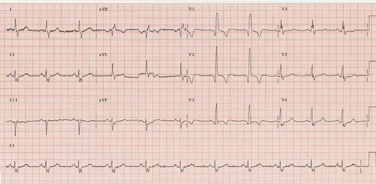 54 y/o male with exertional chest pain What test would you obtain? A. Cardiac catheterization B. Exercise stress test C. Exercise stress test combined with imaging D.