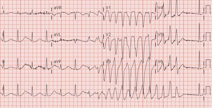 34 year old with syncope Long QT syndrome Calculate the QTc using