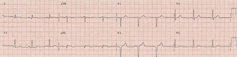 with chest pain ST elevation I, avl, V2