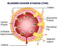 Multiple Primary Rules 58 One Per Lifetime Each patient may only have one invasive urothelial bladder cancer per lifetime.