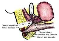 Prostatectomy Perineal, retropubic, suprapubic depends on patient s