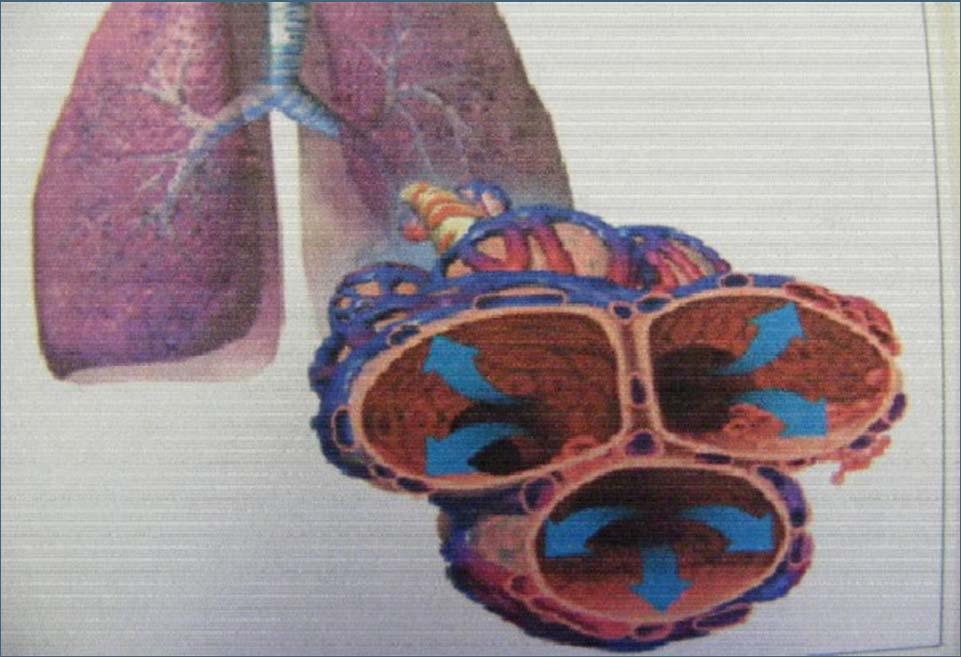 Cardiogenic Pulmonary Edema CPAP: Decreased leakage of fluid into lungs Splints