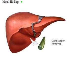 EXC07 - Gallbladder TISR.JA.053 LAB 1.1. Make incision from bottom of xiphoid process to 1 inch superior to pubis using scalpel LAB 1.2.