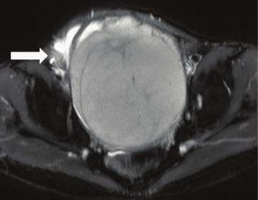 (c) T1W axial image of the abdomen.
