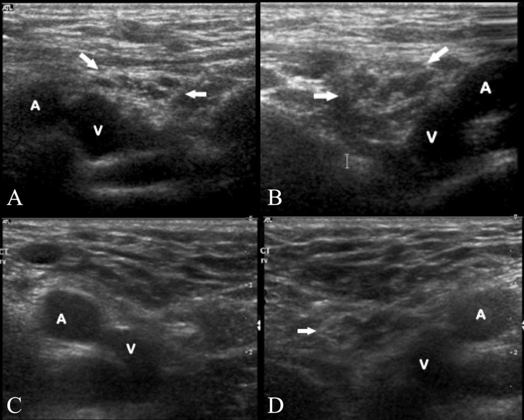 technique was performed as follows. A transverse scan of the inguinal region was obtained just below the inguinal crease with the common femoral artery and vein seen in their transverse axis.