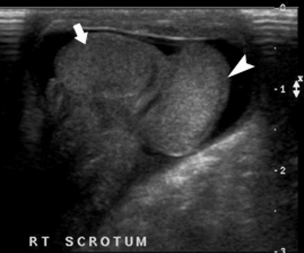 Vijayaraghavan: Non-palpable testis Figure 4 (A,B): Perineal testis. Longitudinal image (A) shows the testis (arrow) in the subcutaneous plane in the perineum, posterolateral to the scrotum.