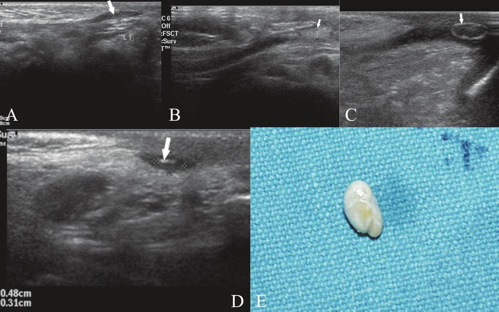 Total calcification Scrotum 8 4 7 6 25 Canalicular 7 2 1 0 10 Abdominal 0 1 0 0 1 15 7 8 6 36 Figure 8: Images show varying appearance of atrophic testis (arrows).