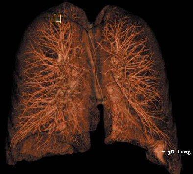 pulmonary disease