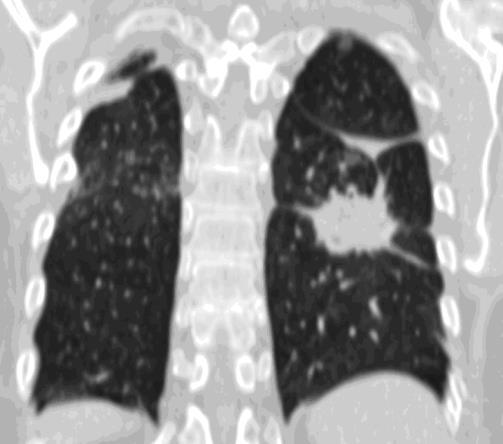 The morphology of nodular pulmonary abnormalities Solitary lung nodules: Tuberculoma, bronchial carcinoma, metastasis, hamartoma, abscess, aspergilloma, adenoma, round atelectasis, AV shunt,