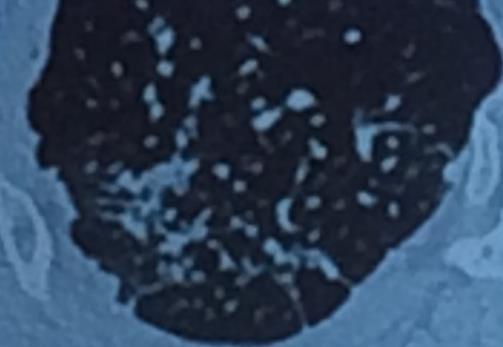plaques calcified hilar lymph nodes Upper