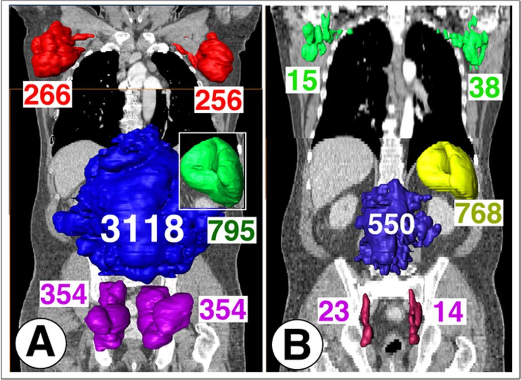 Volumetric Analysis Volumetric analyses of CLL lymph node and spleen manifestation (A) before and (B) during therapy with ibrutinib.