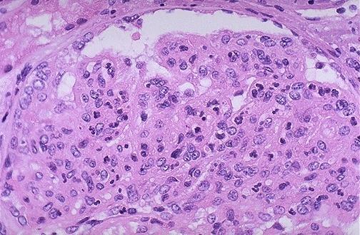 Post-streptococcal glomerulonephritis is due to increased numbers of epithelial,