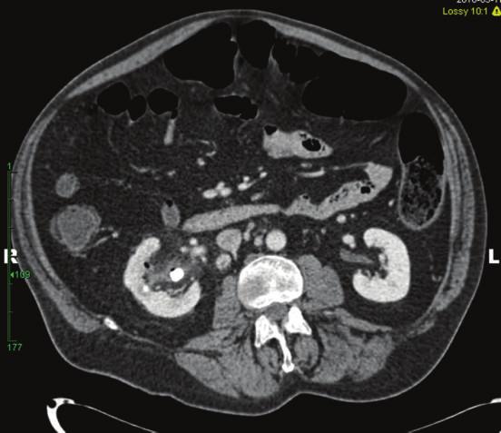2 Case Reports in Medicine Figure 1: CT abdomen with contrast demonstrates right nephrolithiasis, stranding of the renal pelvis, and gas within the right collecting system.