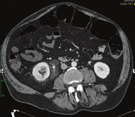 There is no presence of gas in the wall of the bladder to suggest emphysematous cystitis.