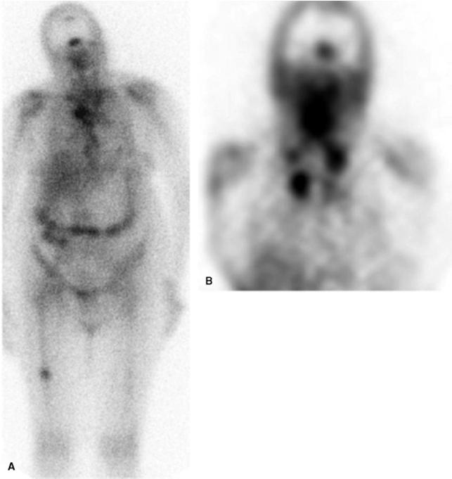 67Ga-scintigraphy in FUO Long time assumed «gold standard», Pros acute and chronic inflammatory conditions Some neoplasms Con s Poor specificity Duration of imaging, suboptimal decay Largest study:
