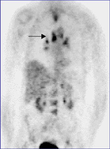 FDG PET(-CT) IMAGING IN FUO 70-year-old female fever, fatigue and weight loss of 3 weeks duration.