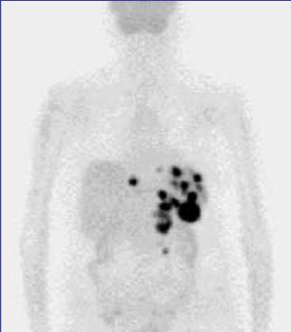 Symptoms resolved upon treatment with corticosteroids Bleeker-Rovers, EJNMI 2007; 34:694-703 FDG PET(-CT) IMAGING IN FUO 76-year-old female Fever and weight loss Blood,urine,