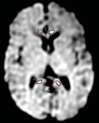 A, T2-weighted MR image at level of internal capsule shows normal appearance of brain.