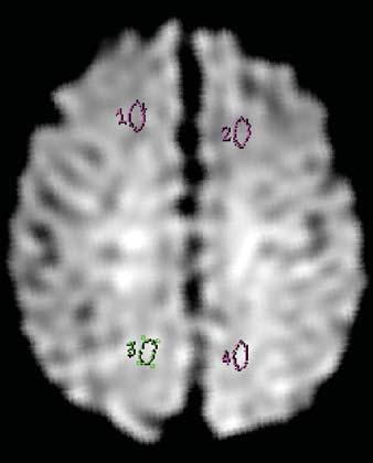 I, Diffusion-weighted image at level corresponding to H shows ROI placement in frontal subcortical white matter and parietal subcortical white matter.