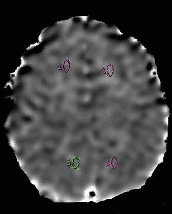 07 10 3 mm 2 /s. K, Diffusion tensor image shows ROI placement in frontal subcortical white matter and parietal subcortical white matter.