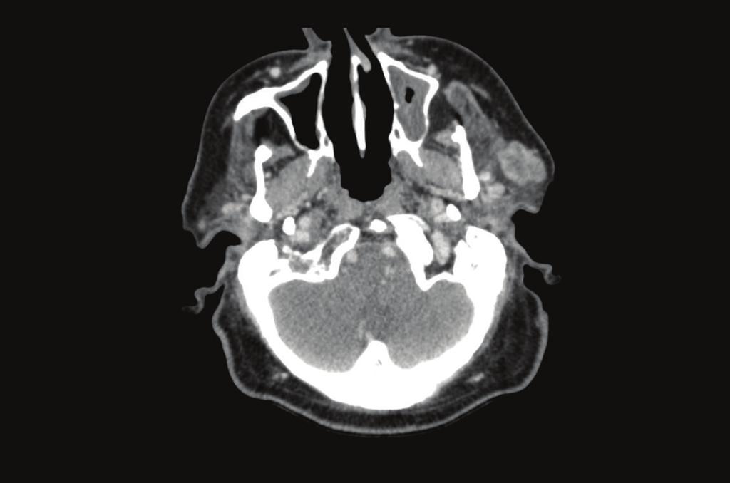 The left facial nerve and its branches were identified and preserved with blunt dissection. The parotid gland containing the tumour was resected.