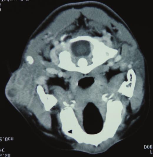 2 Case Reports in Otolaryngology (a) (b) Figure 1: CT findings. (a) A 45 40 mm tumor is apparent in the right parotid gland.