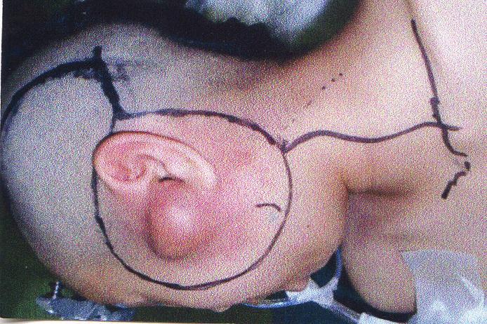 Discussion Figure 2: Skin incision. Resection of skin, including pinna. As radical therapy, surgery was performed to resect the skin, including the pinna (Figure 2).