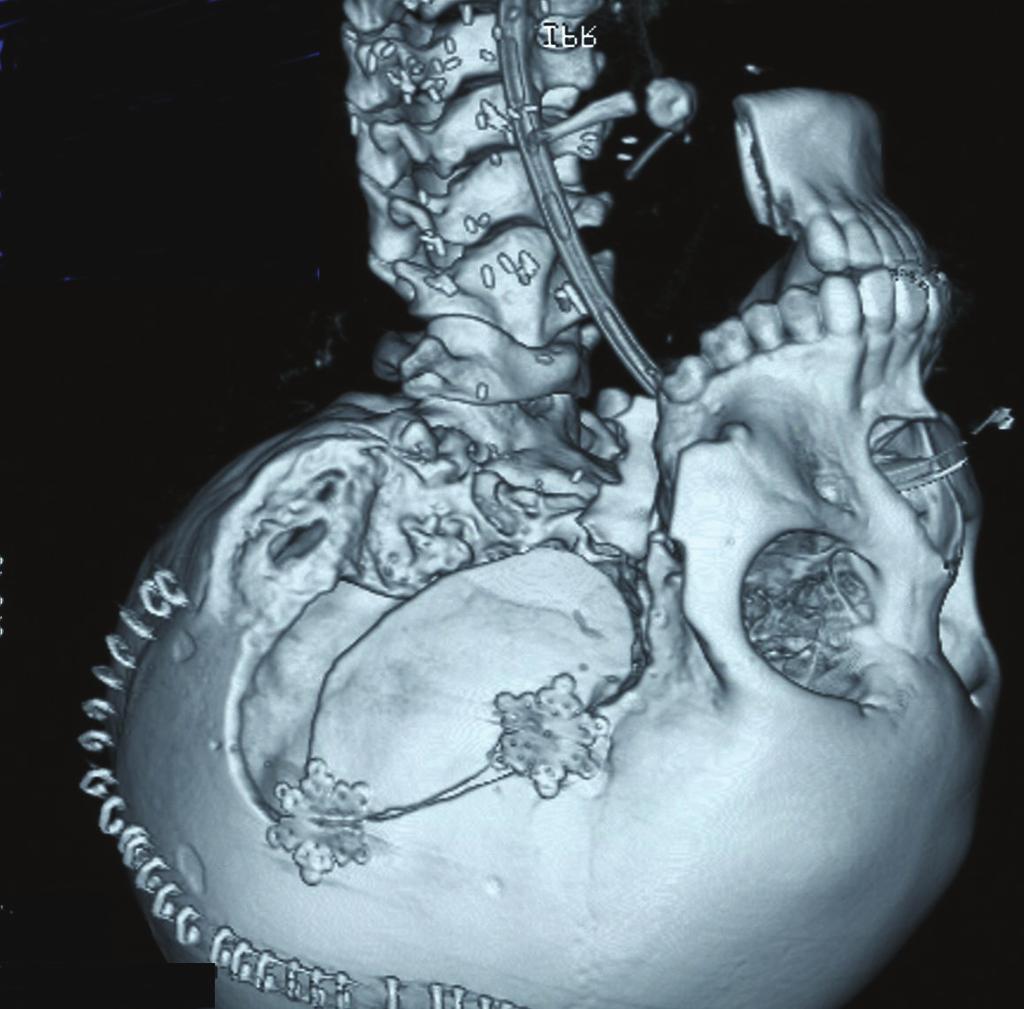 Facial nerves were resected at the same time. Figure 5: Pathological findings for high-grade malignancy. A large number of strongly heteromorphic, solid foci are apparent.