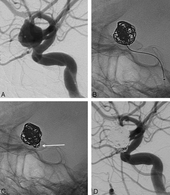 Fig 2. A 50-year-old woman with an incidentally discovered unruptured ophthalmic aneurysm. A, Lateral internal carotid angiogram demonstrates 9-mm ophthalmic aneurysm.
