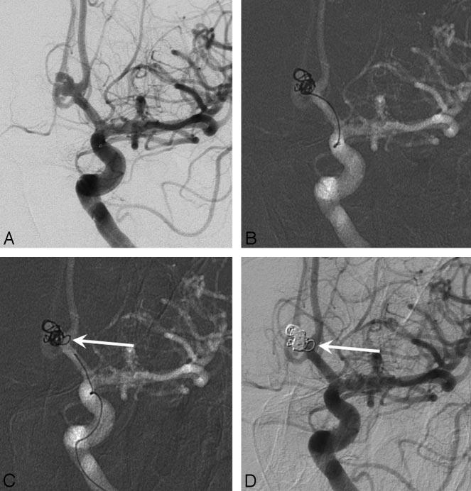 Fig 3. A 62-year-old man with grade III SAH from anterior communicating artery aneurysm. A, Internal carotid angiogram shows bilobated 5-mm anterior communicating artery aneurysm.