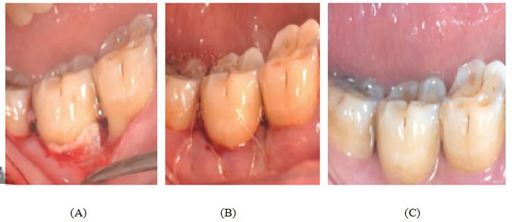 Application of platelet rich fibrin combined with atorvastatin in the regeneration treatment of degree II furcation involvements of mandibular molars Evaluation index (1) The preoperative and plaque
