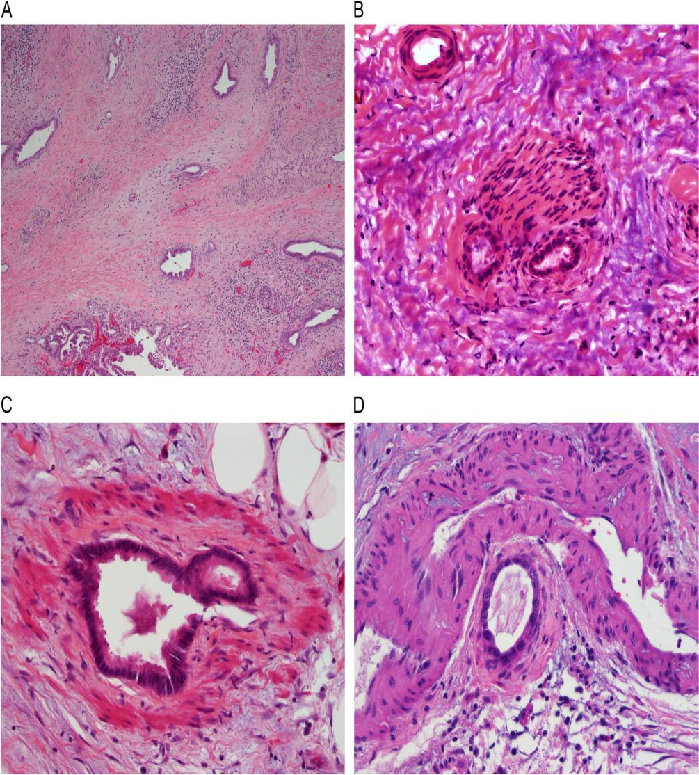 Eight features supportive of the diagnosis of ductal adenocarcinoma (A)