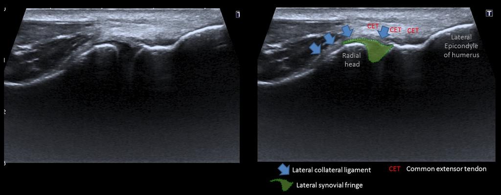 Fig. 18: Lateral elbow. Longitudinal view. (Common extensor tendon) References: Cyprian Olchowy, Wroclaw Medical University, Poland 4.