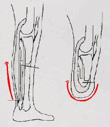TT Amputation: General Principles - Flap Length = Diameter + 1cm - Rotation Point Posterior to Leg - Slight Angle Back to