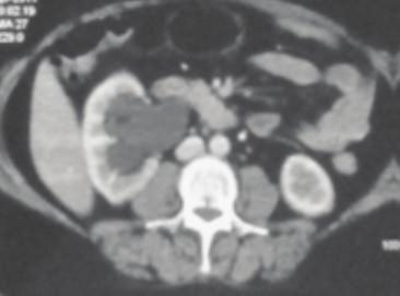 Right external iliac, left gastric, and epiphrenic lymphadenopathy was resolved.